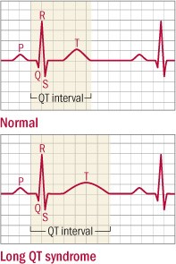 What Does Prolonged Qt Mean What Does